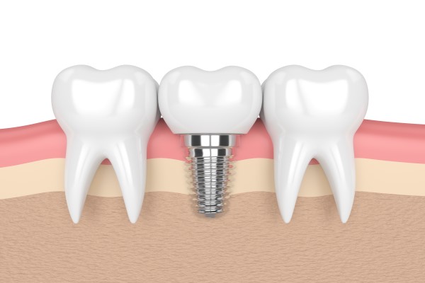 Bone Regeneration For Dental Implants