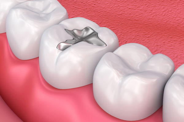 Dental Restorations: Choosing Between Fillings And Crowns