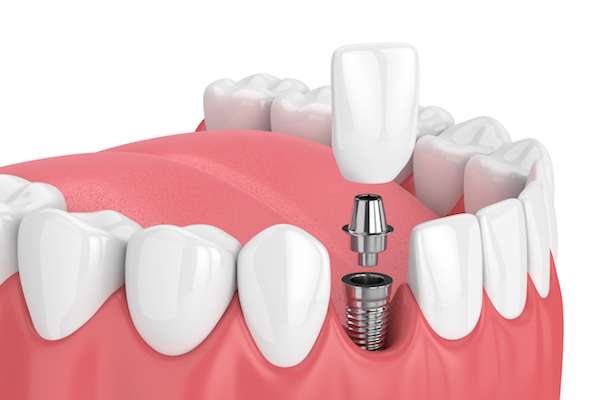 How Painful is Dental Implant Surgery from Signature Smiles of Park Ridge in Park Ridge, IL