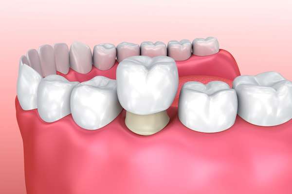 Permanent Dental Crowns vs. Temporary: Is There a Difference from Signature Smiles of Park Ridge in Park Ridge, IL