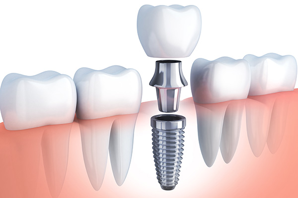Questions to Ask Your Implant Dentist from Signature Smiles of Park Ridge in Park Ridge, IL