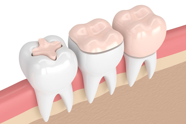 What Type of Materials Are Used in Dental Restorations? from Signature Smiles of Park Ridge in Park Ridge, IL